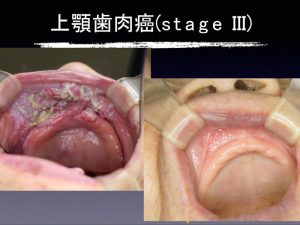 親知らず 抜歯 後 白い