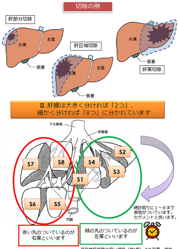 下痢 胆嚢 摘出